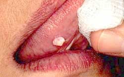 papillomavirus langue blanche