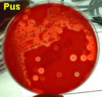 LE DIAGNOSTIC BACTERIOLOGIQUE D'UNE INFECTION BACTERIENNE II